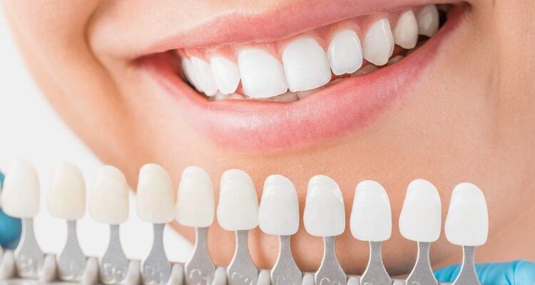 Вініри: Повне керівництво – що це і кому підходять ці накладки?