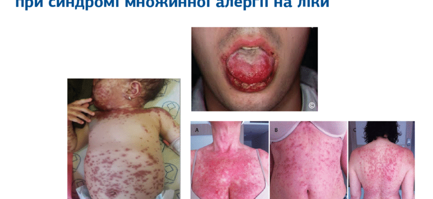 Як виявити перші ознаки алергії на лікарський препарат: поради