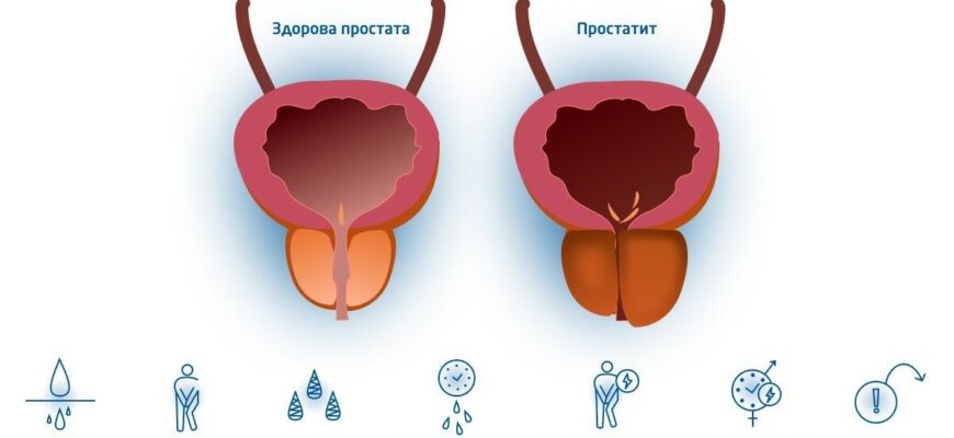 Що не можна їсти при простатиті: заборонені продукти та рекомендації