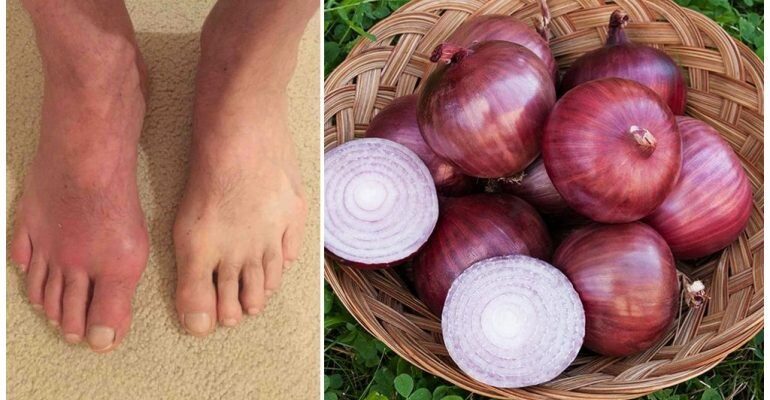 Чи можна їсти часник при подагрі: вплив та рекомендації лікарів