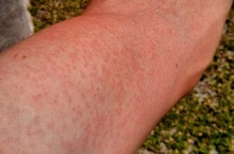 Що означає вірус Зіка: симптоми, поширення та методи захисту