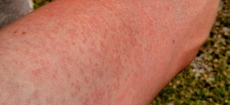 Що означає вірус Зіка: симптоми, поширення та методи захисту