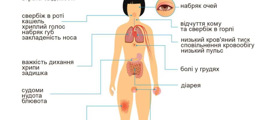 Як виникає алергія: причини, симптоми та способи запобігання