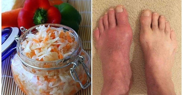 Чи можна їсти квашену капусту при подагрі: поради та рекомендації