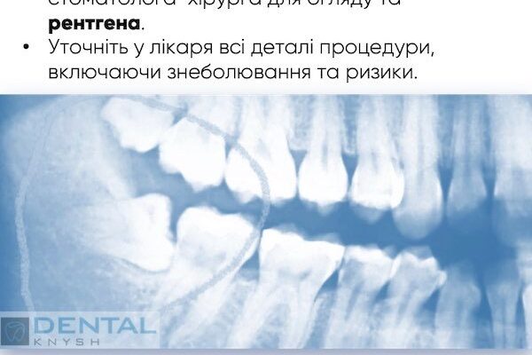 Чи можна їсти перед видаленням зуба мудрості: важливі поради стоматологів