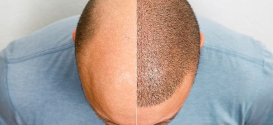Чи можливо повністю вилікувати рубцеву алопецію: сучасні методи та поради