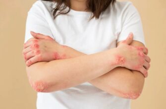Екзема: основні причини, симптоми та ефективні методи лікування