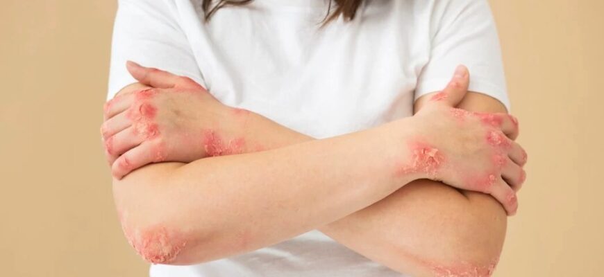 Екзема: основні причини, симптоми та ефективні методи лікування