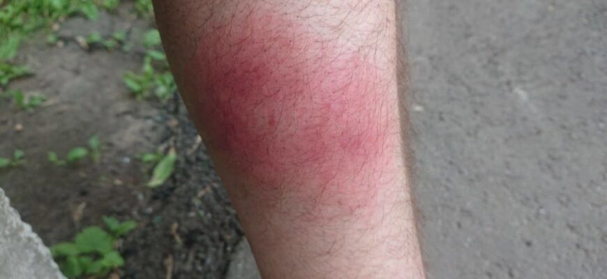 Ефективні засоби для зняття набряку від укусу мошки: поради та методи