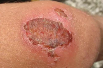 Що робити, якщо рана запалилася: кроки лікування та догляду