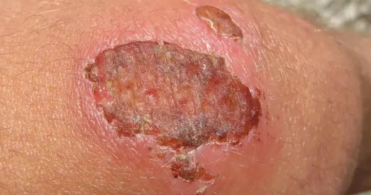 Що робити, якщо рана запалилася: кроки лікування та догляду