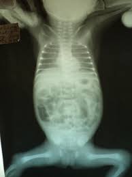 Розуміння Кишкової непрохідності: Симптоми, Причини та Лікування