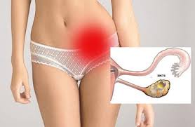 Все, що потрібно знати про кісту яєчника: визначення, причини, лікування