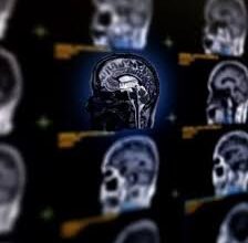 Кіста в голові: визначення, симптоми та методи лікування проблеми