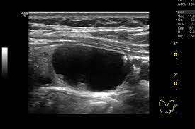 Що таке Кіста Бейкера: причини, симптоми та лікування захворювання