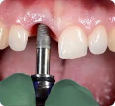 Імплантація: що це таке та які її особливості у медицині?