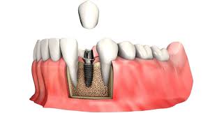 Що таке Імплантація зубів: повний гід по сучасним технологіям