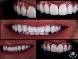 Що таке коронка на зуб: ключові факти для здоров’я вашої усмішки