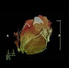 Коронарографія серця: що це таке та чому вона важлива для здоров’я?