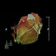 Коронарографія серця: що це таке та чому вона важлива для здоров’я? Коронарографія серця: що це таке та чому вона важлива для здоров’я?