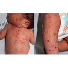 Короста: що це таке, основні симптоми та як вилікувати захворювання