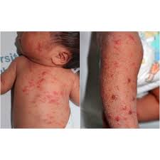 Короста: що це таке, основні симптоми та як вилікувати захворювання Короста: що це таке, основні симптоми та як вилікувати захворювання