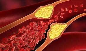 Що таке Коефіцієнт атерогенності та як його визначити: повний гайд