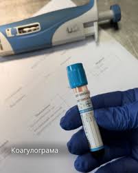 Що таке коагулограма крові: важливість та призначення аналізу Що таке коагулограма крові: важливість та призначення аналізу