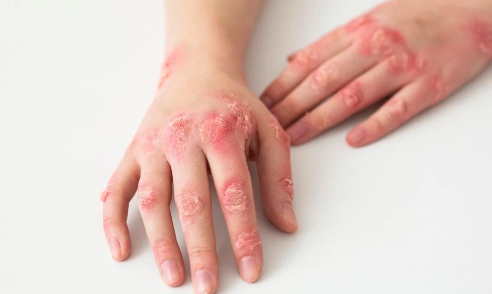 Екзема на руках