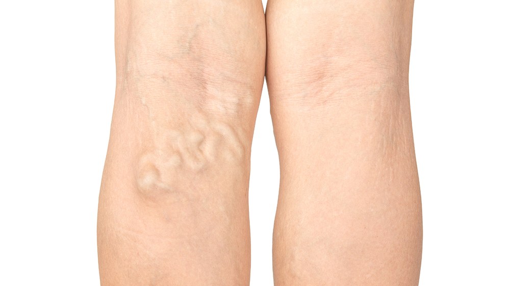 Лікування варикозу