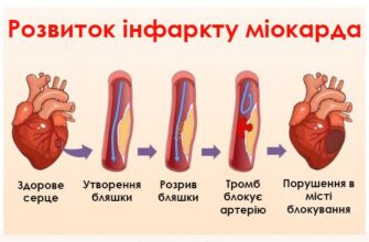 Чи можна їсти мед після інфаркту: користь та ризики для здоров’я