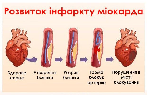 Чи можна їсти мед після інфаркту: користь та ризики для здоров’я