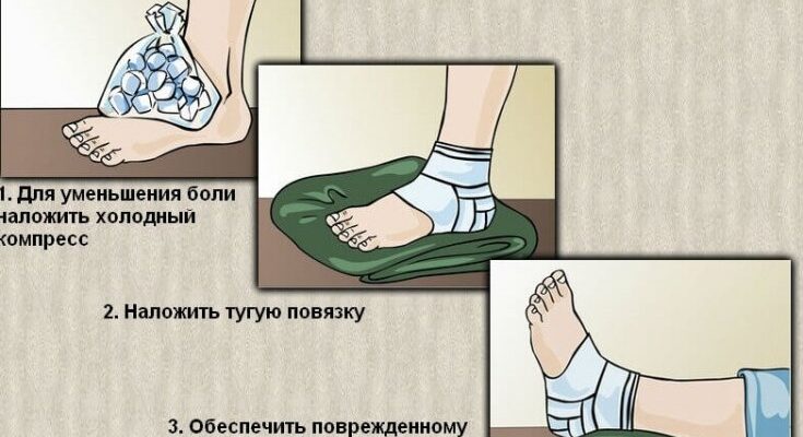 Перша допомога при розтягненні зв’язок: що робити в перші хвилини?