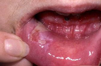 Ознаки та симптоми пухирчатки в ротовій порожнині: ключові деталі