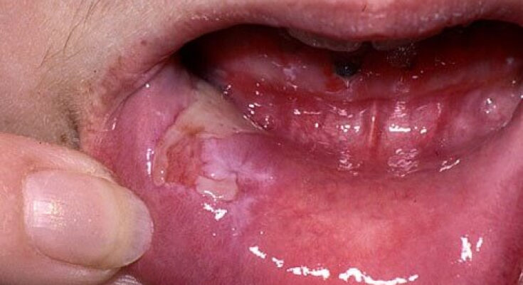Ознаки та симптоми пухирчатки в ротовій порожнині: ключові деталі