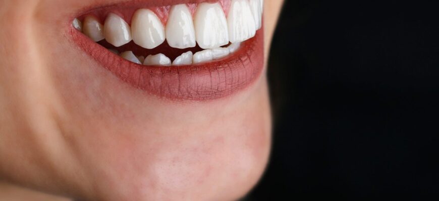 Кому підходять вініри: особливості, переваги та можливі обмеження Кому підходять вініри: особливості, переваги та можливі обмеження