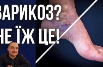 Що не можна їсти при варикозі: продукти, від яких слід відмовитися