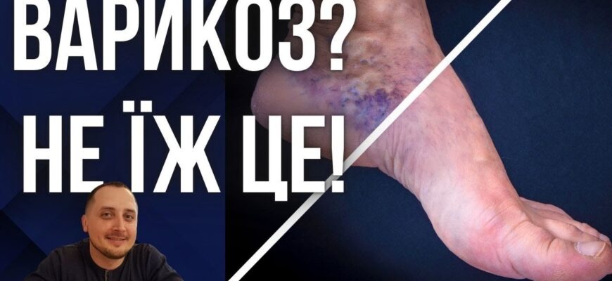 Що не можна їсти при варикозі: продукти, від яких слід відмовитися