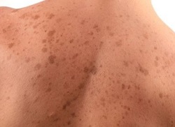 Причини появи коричневих плям: основні фактори та їх вирішення