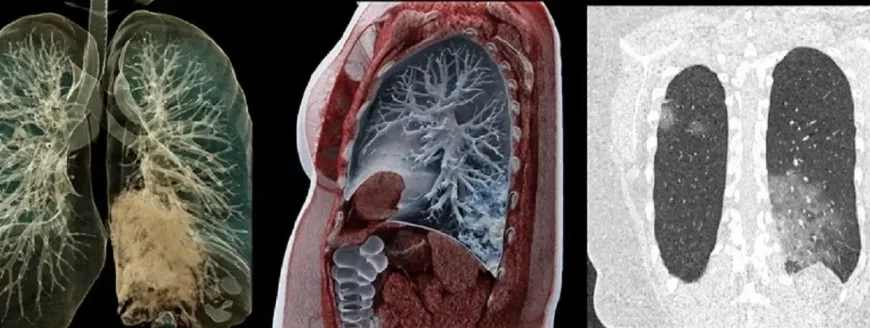 Чи безпечно робити комп’ютерну томографію двічі на місяць?