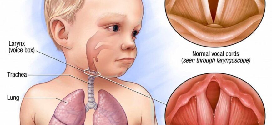 Невідкладна допомога при несправжньому крупі: поради та дії