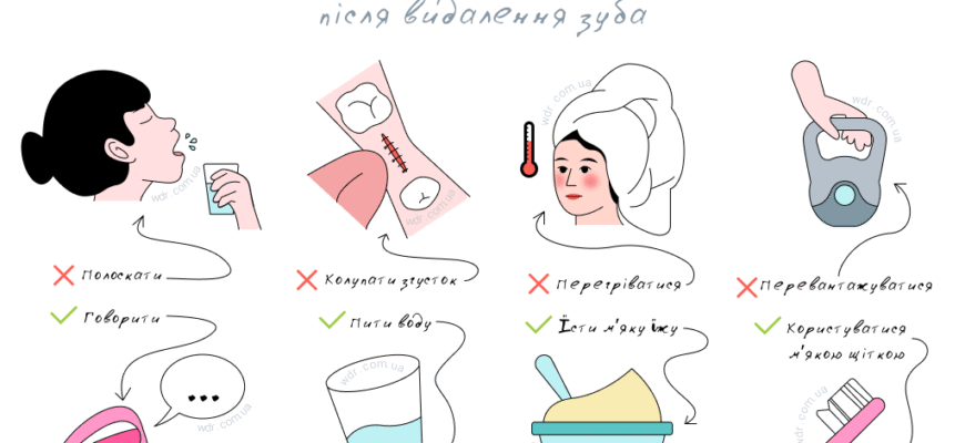 Що не можна їсти після видалення зуба мудрості: перелік продуктів