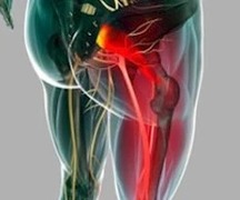 Як швидко зняти гострий біль сідничного нерва за допомогою ліків