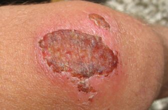 Що таке струп: значення слова та його використання в українській мові