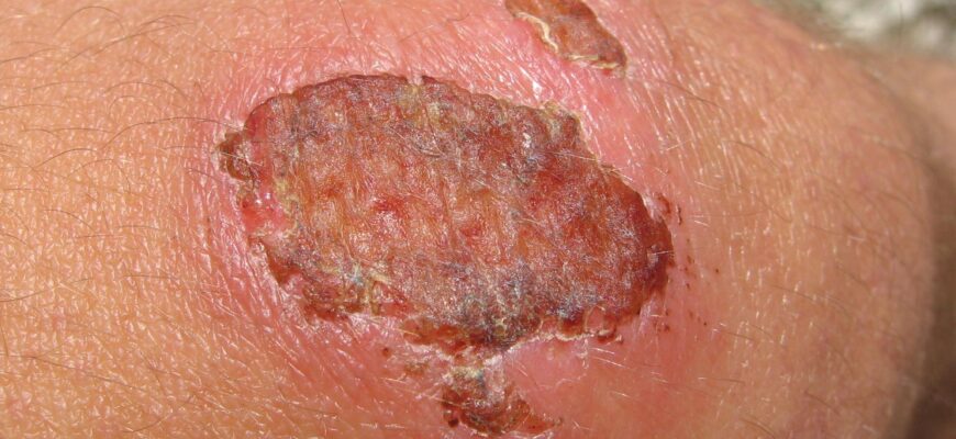 Що таке струп: значення слова та його використання в українській мові