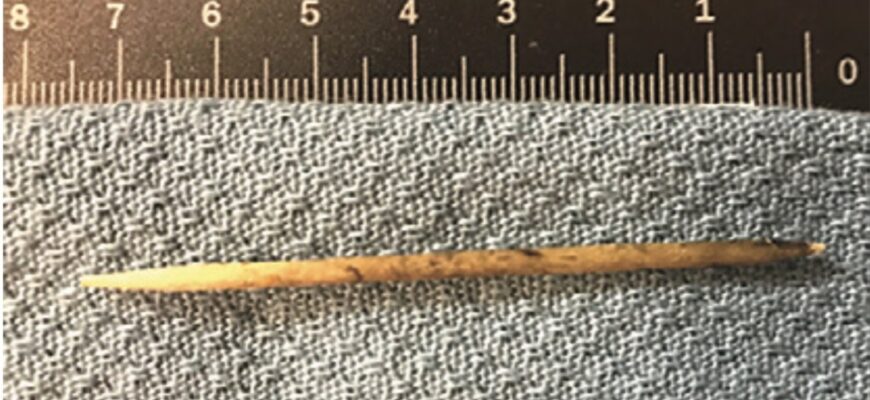 Загрози та наслідки випадкового проковтування зубочистки: чого чекати?