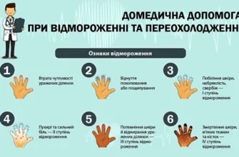 Перша медична допомога при обмороженні: основні правила та поради