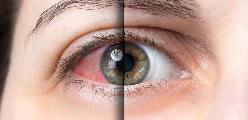 Сухість очей: причини виникнення та ефективні методи лікування Сухість очей: причини виникнення та ефективні методи лікування