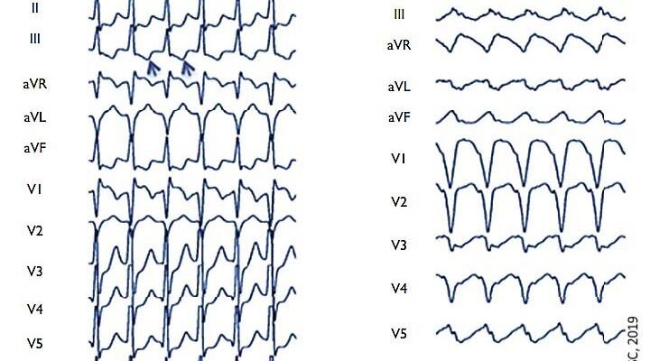 Ефективна невідкладна допомога при синдромі WPW: що потрібно знати