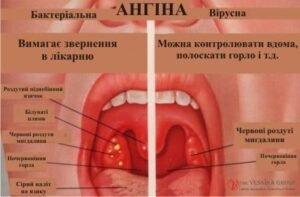 Що їсти при ангіні: рекомендації для швидкого одужання